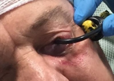 Man blinded by carrier strap